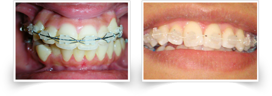 ceramic braces at smile please