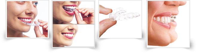 Invisible aligners in Navi Mumbai