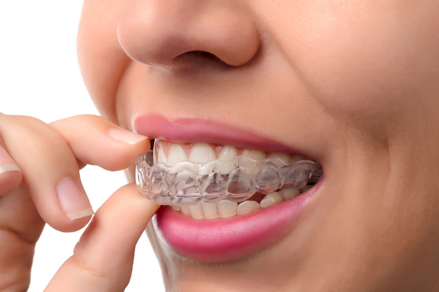 invis, best Invisalign dentist near me