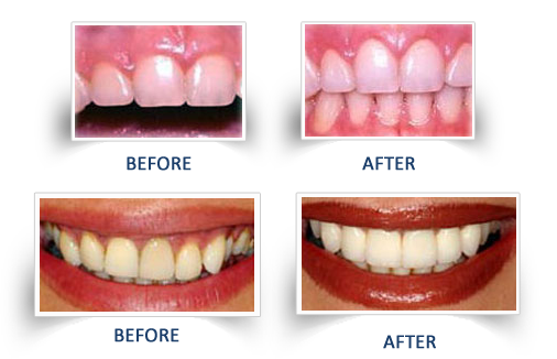 Cosmetic gum Treatment