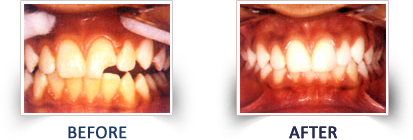 Composite Filling (Tooth Colored Filling)