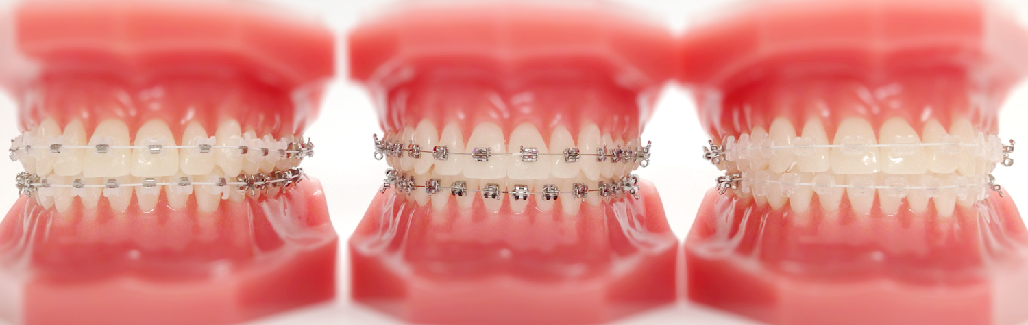 self-ligating braces at Smile please dental clinic