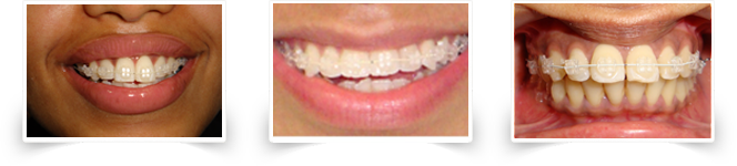 Mono-crystalline ceramic braces at Smile Please Dental Clinic