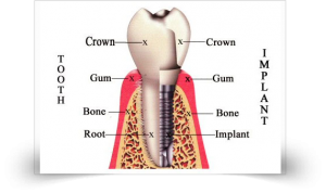 Dental Implants In India