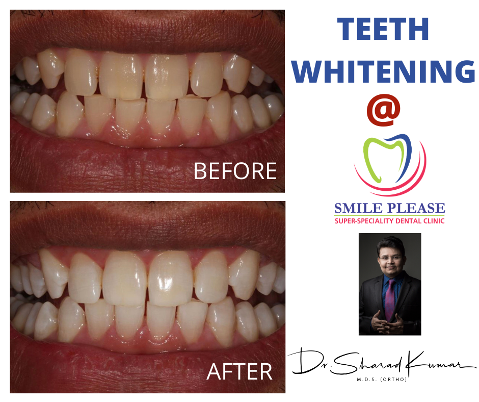 Best in office 1 hour Teeth Whitening at Smile Please Dental clinic in sector 17, vashi, Navi Mumbai.