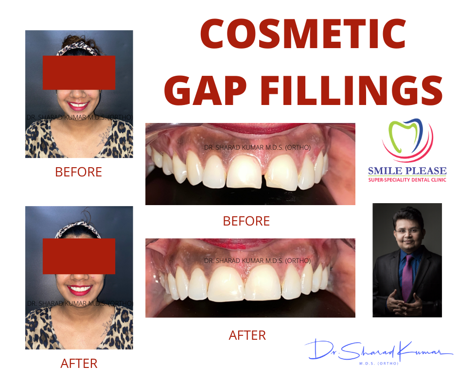 BEST DENTAL CLINIC FOR filling gaps in between teeth. Midline diastema. Best dentist. Invisalign. INVIS. Smile Designing