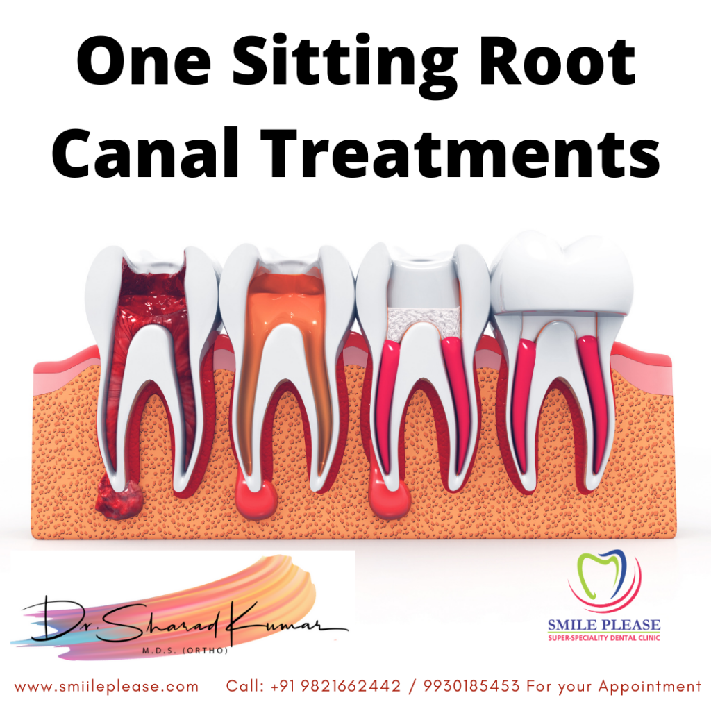 One sitting root canal treatments at smile please dental clinic