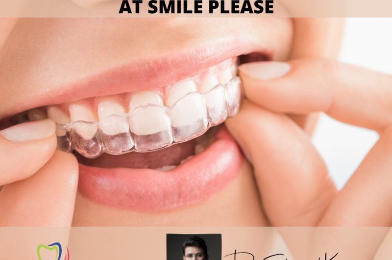 Invisalign® SmileView™ @ Smile Please